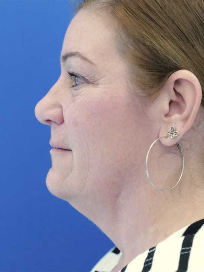 Full Upper and Lower Facelift — Before
