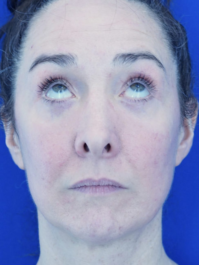 Quad Eyelid Blepharoplasty with Fat Reposition — After