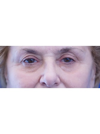 Eyelid Rejuvenation and Fat Transfer to Cheek* — Before