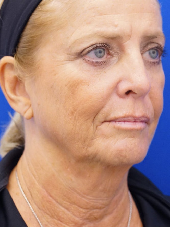 Deep Plane Lower Facelift — Before