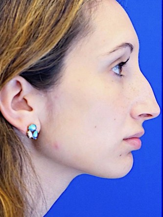 Nasal Profile Aesthetics — Before