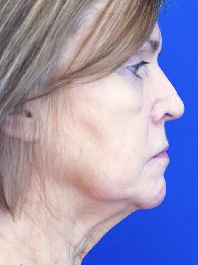 Deep Plane Lift and Fat Grafting — Before