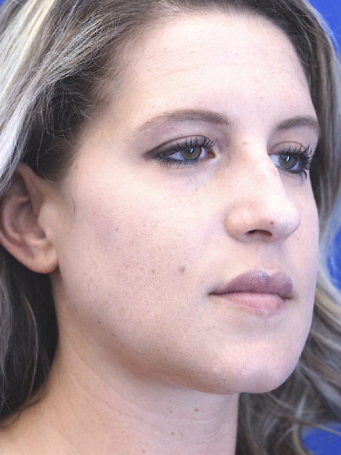 Aesthetic Nasal Profile — Before