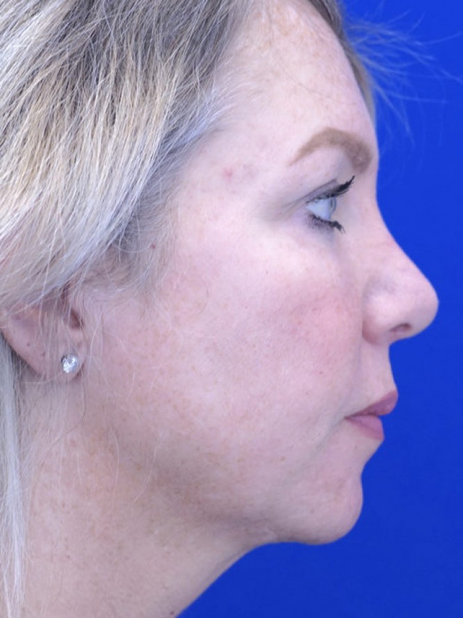 Tip Ptosis — After