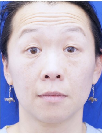 Unilateral Ptosis Repair* — After