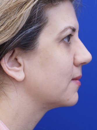 Extended Lower Blepharoplasty* — After