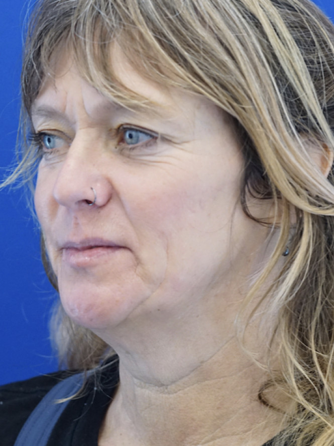 Fantastic Facial Profile — Before