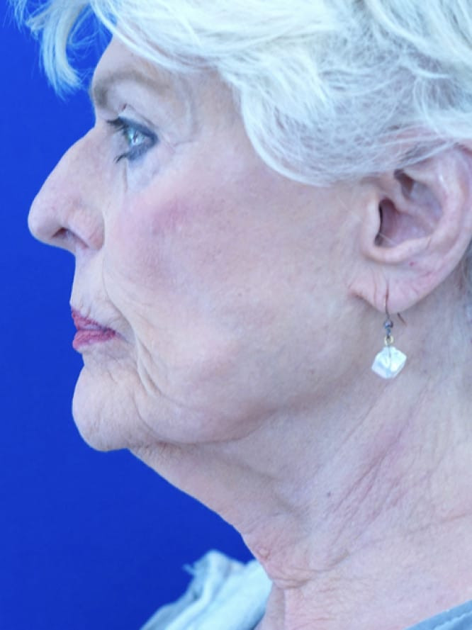 Deep Plane Lift and Platysmaplasty — Before