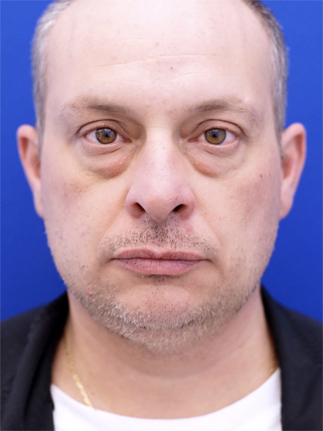 Orbital Fat Reposition — Before