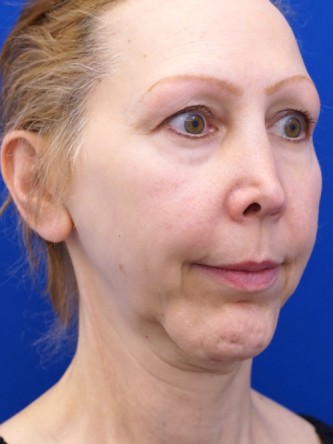 Revision Chin Implant, Mini Lift* — Before