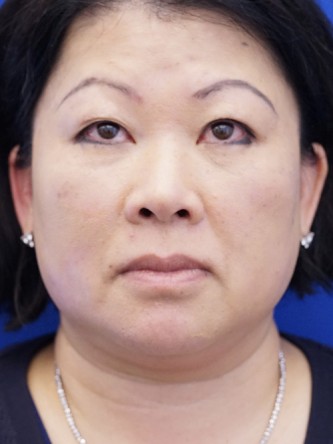 Asian Blepharoplasty — Before