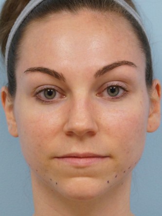 Fractional CO2 Laser Skin Resurfacing1* — Before