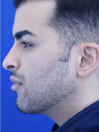 Vertical Lengthening Chin* — After
