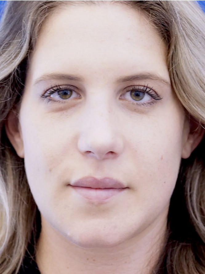 Aesthetic Nasal Profile — After