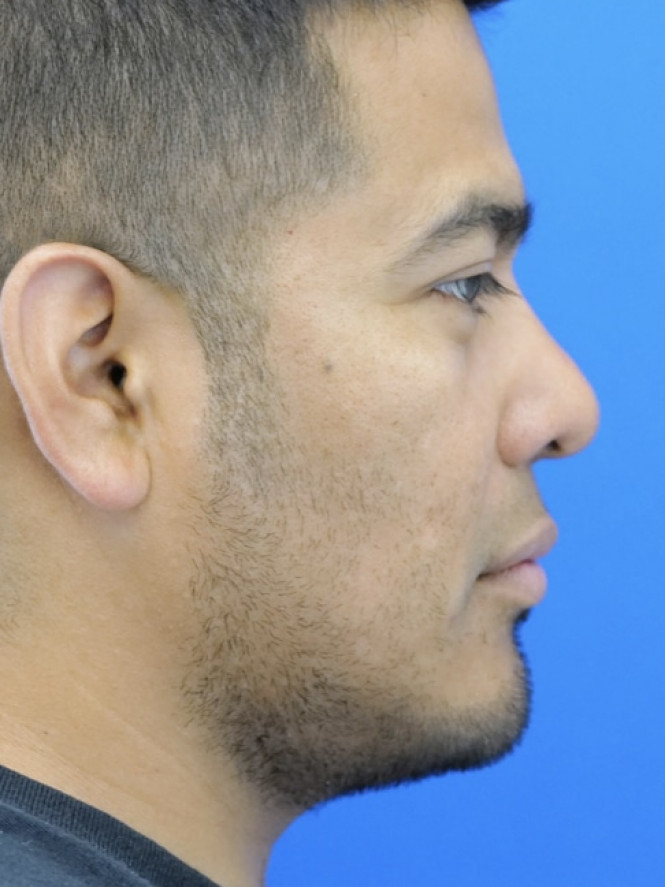 Rhinoplasty Trifecta — After