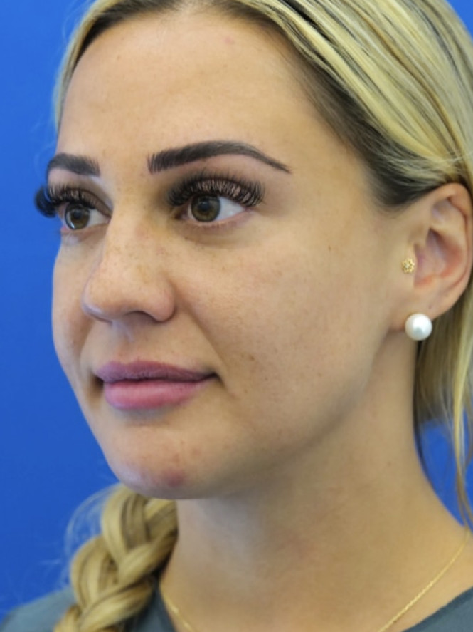 Lower Facial Rejuvenation — After