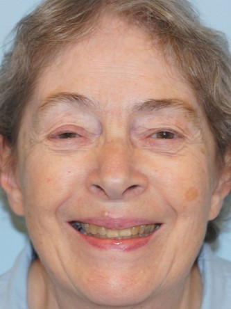 Visual Field Deficit – Eyelid Ptosis3* — Before