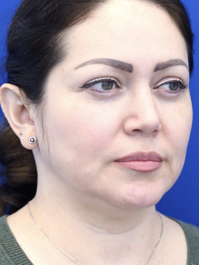 Nasal Tip Asymmetry — After