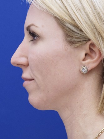 Enhance Chin Projection* — Before