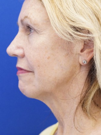 Deep Plane Lift and Superficial Laser — Before
