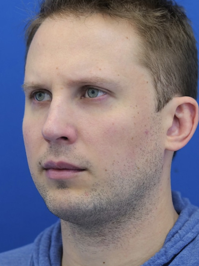 Dorsal Hump and Chin Augmentation — After