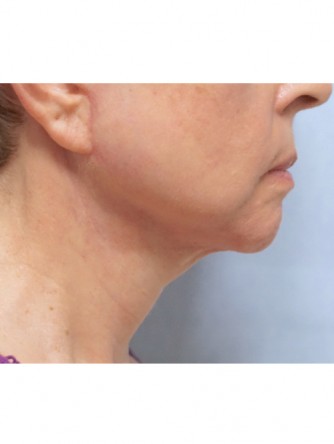 Neck Lift* — After