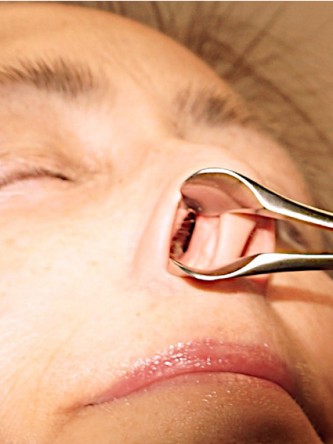 Nasal Septal Perforation2* — Before