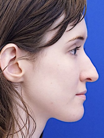 Nasal Profile Irregularity — Before