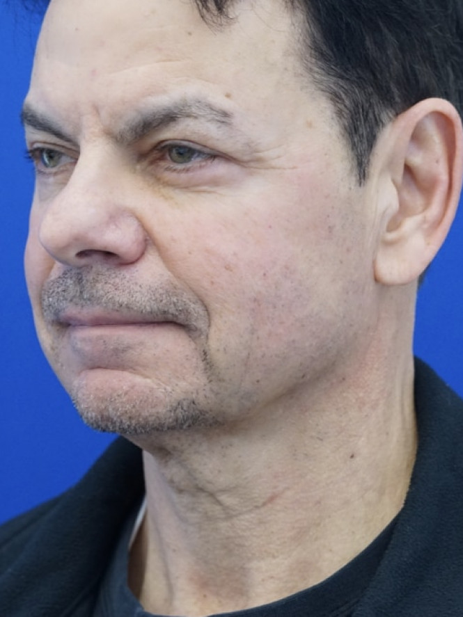 Neck Loose Skin — Before