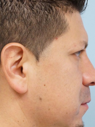 Protruding Ears – Upper Third* — Before