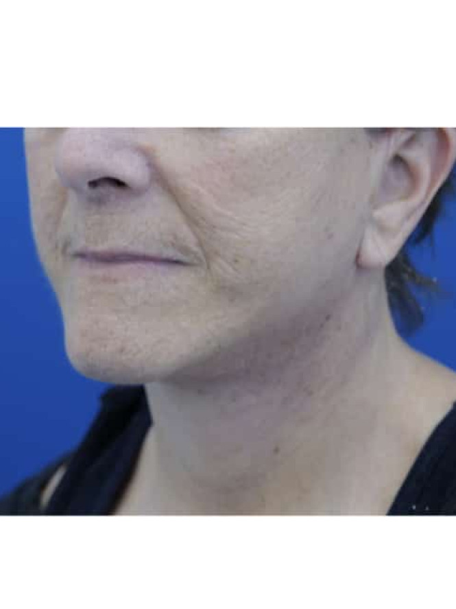 Neck Tissue Laxity — After