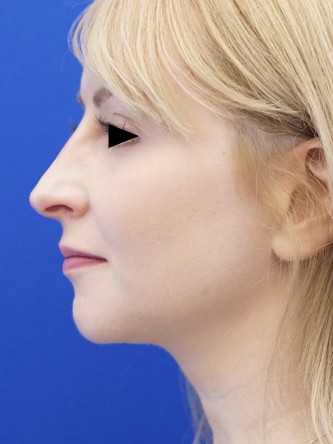 Nasal Profile Camouflage — After