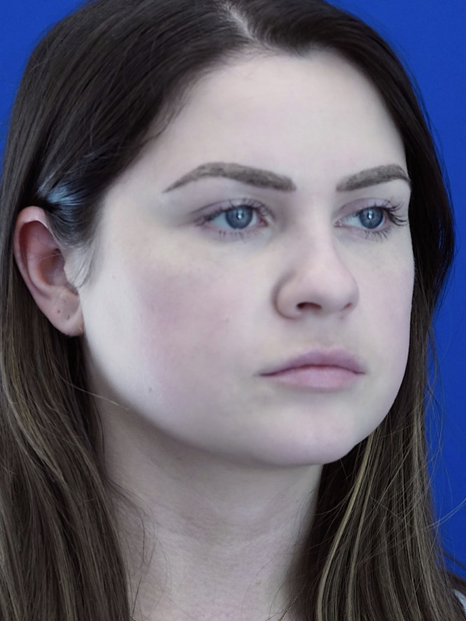 Nasal Tip and Narrow Cheek — Before