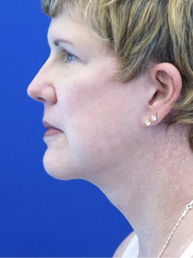 Facelift Platysmaplasty with Subplatysmal Lipectomy — After