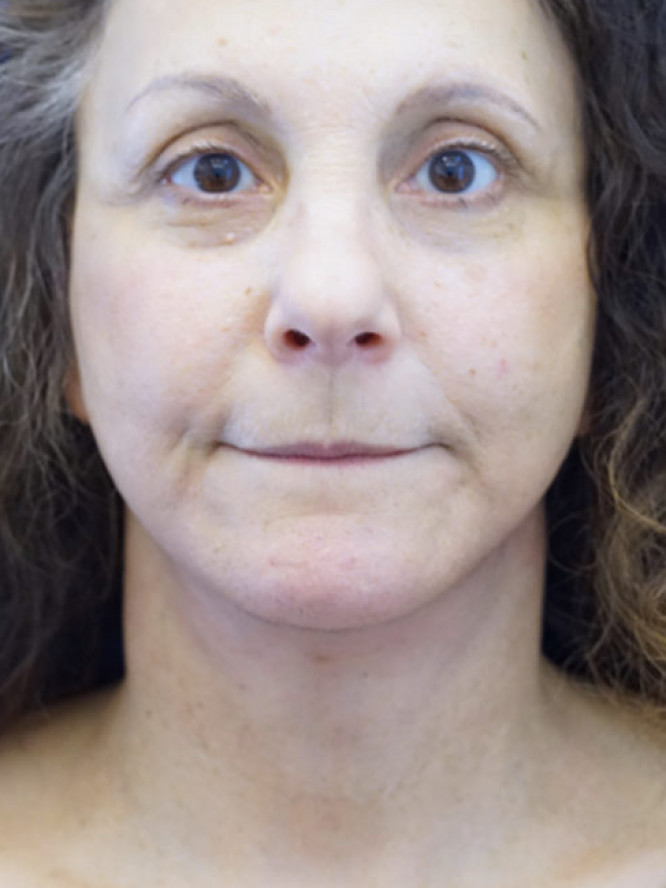 Deep Plane Facelift and Platysmaplasty — After