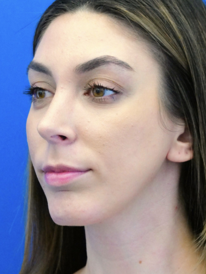 Facial Profile Balance — After