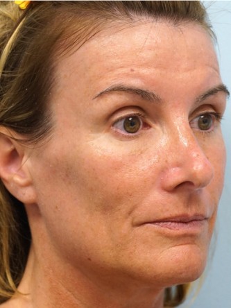 Voluma to Malar Cheek* — Before