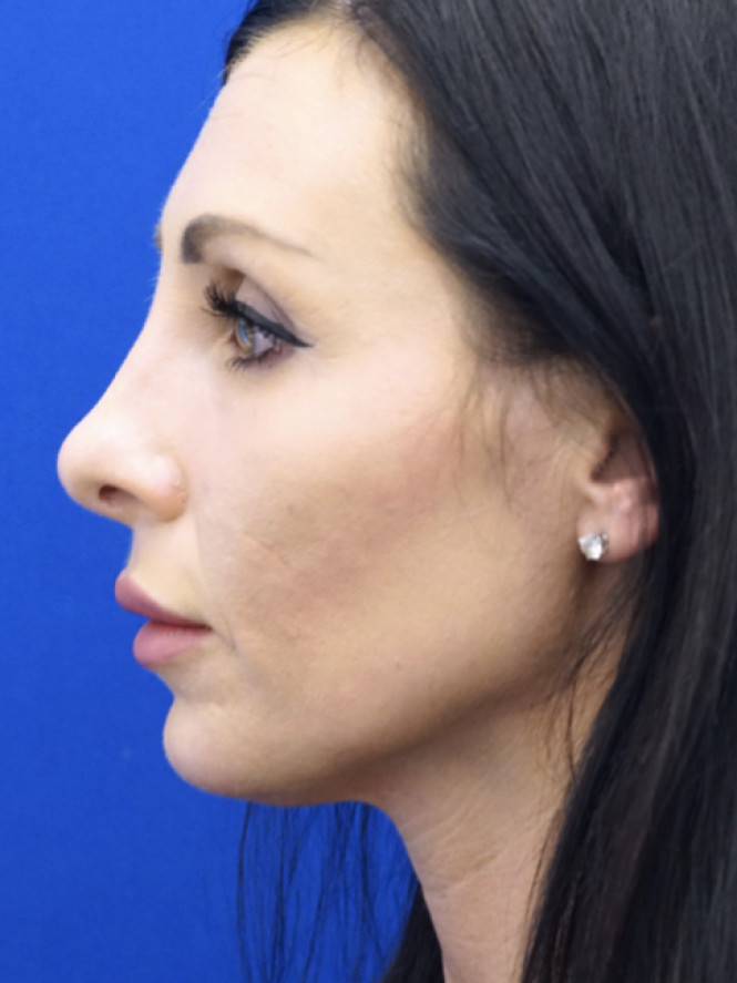 Downturn Tip Endonasal Rhinoplasty — After