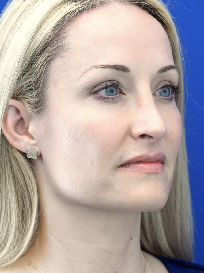 Trichophytic Browlift — After