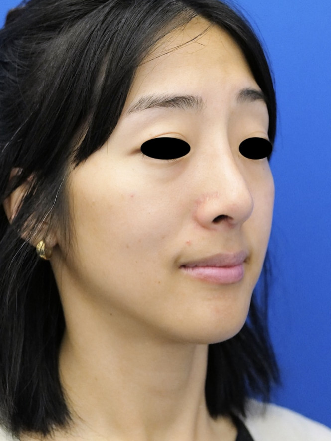 Preservation Ethnic Rhinoplasty — After