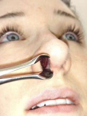 Nasal Profile Irregularity — After