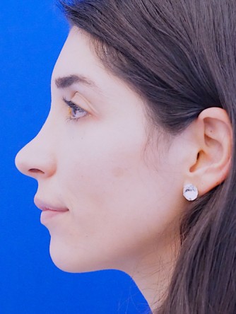 Nasal Bridge Bump* — After