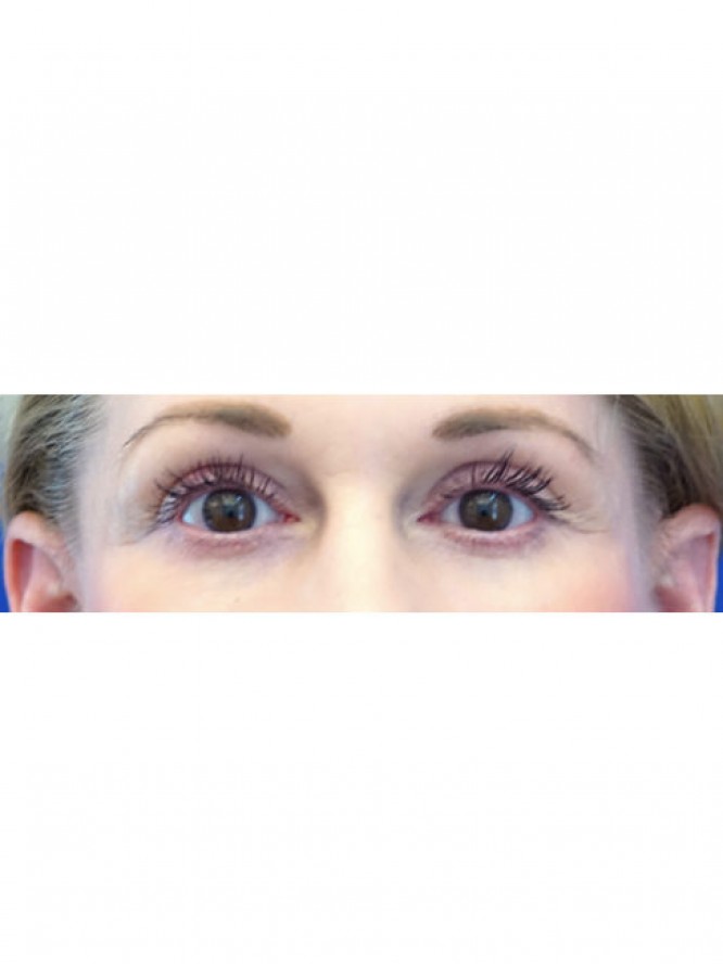 Lower Blepharoplasty and Fat Grafting — After