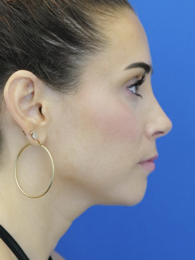 Mild Hump Reduction — After