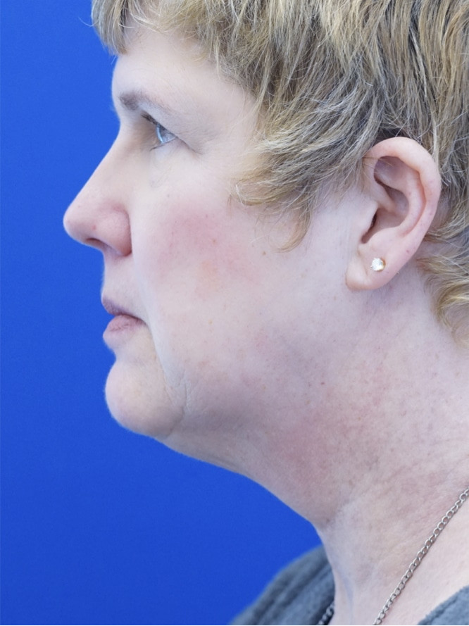 Facelift Platysmaplasty with Subplatysmal Lipectomy — Before