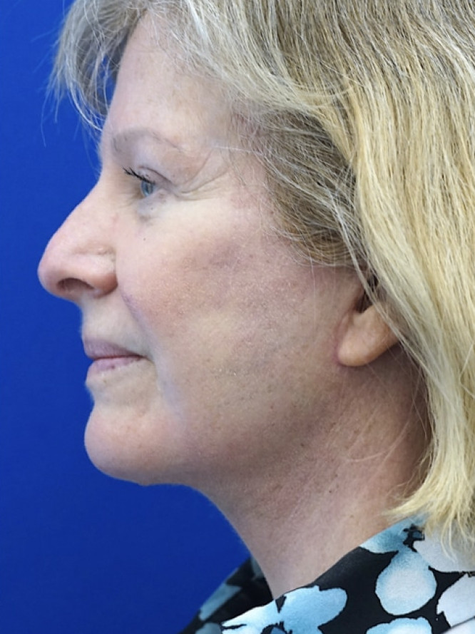 Deep Plane Jowl and Neck Lift — After