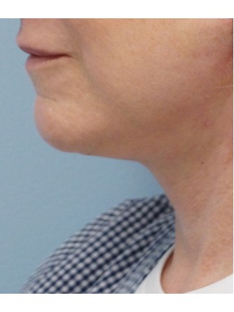 Redundant Neck Skin* — After