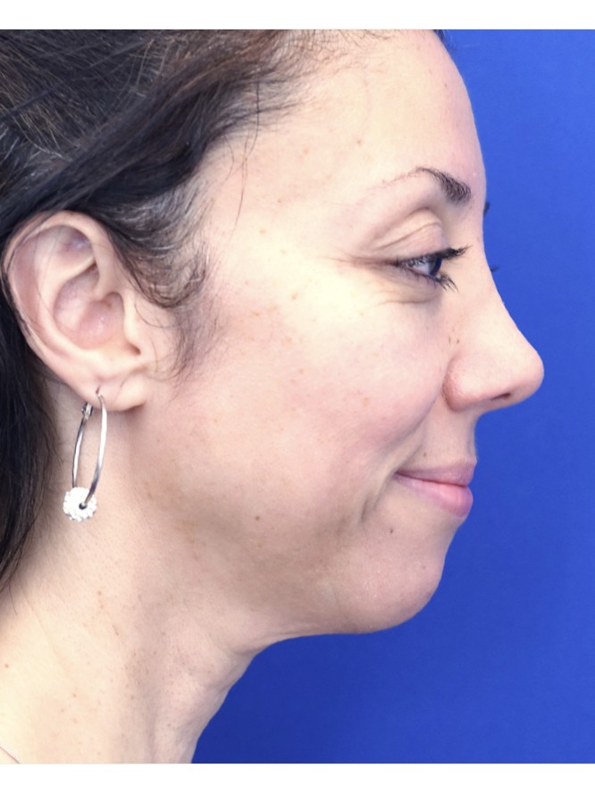 Natural Result — After