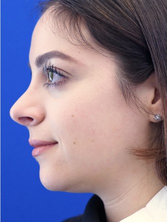 Finesse Nasal Aesthetics* — After