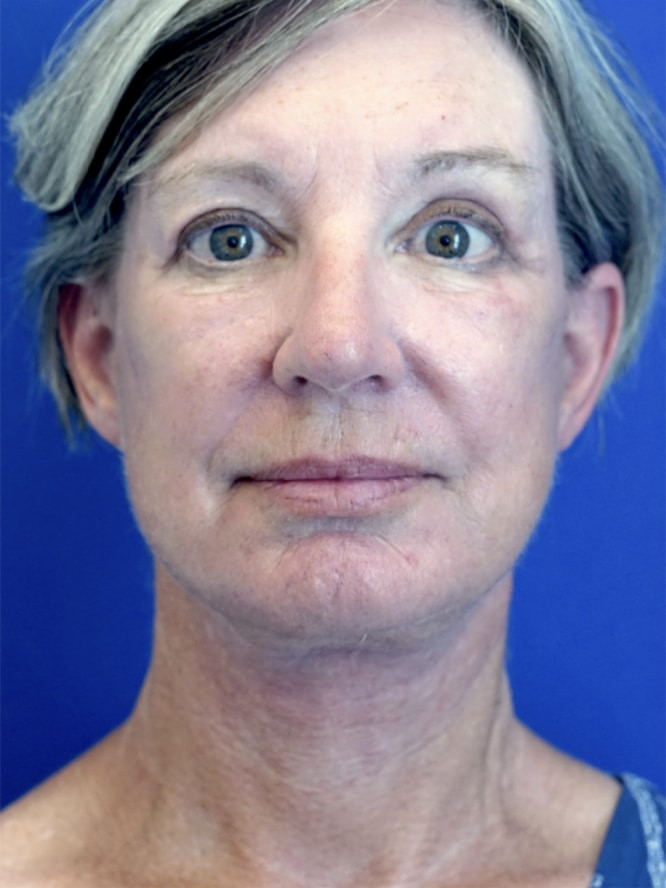 Deep Plane Face and Neck Lift — After